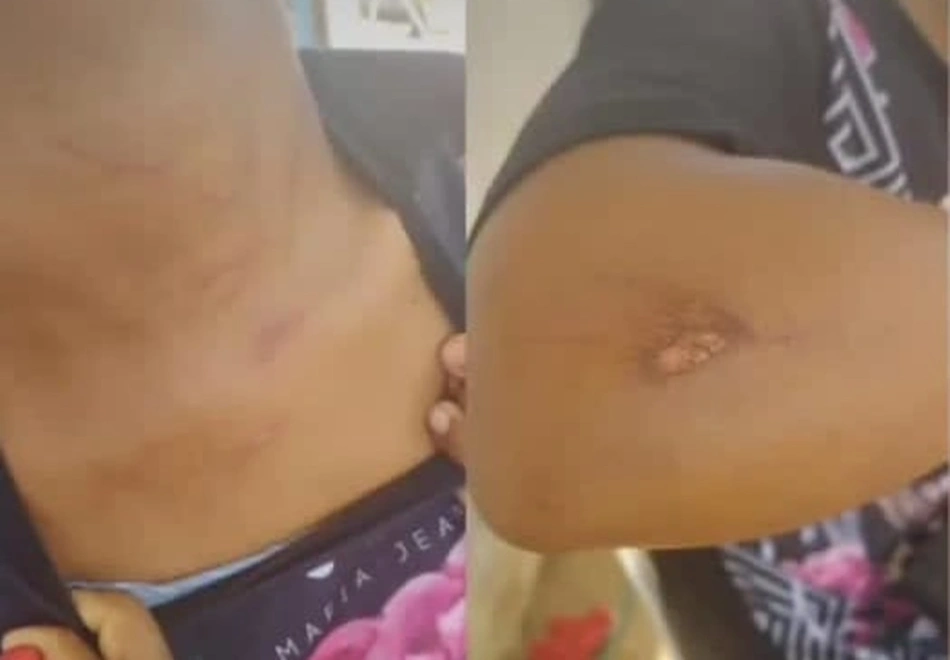 Foto mostra lesões nos corpos das jovens agredidas no município de João Costa