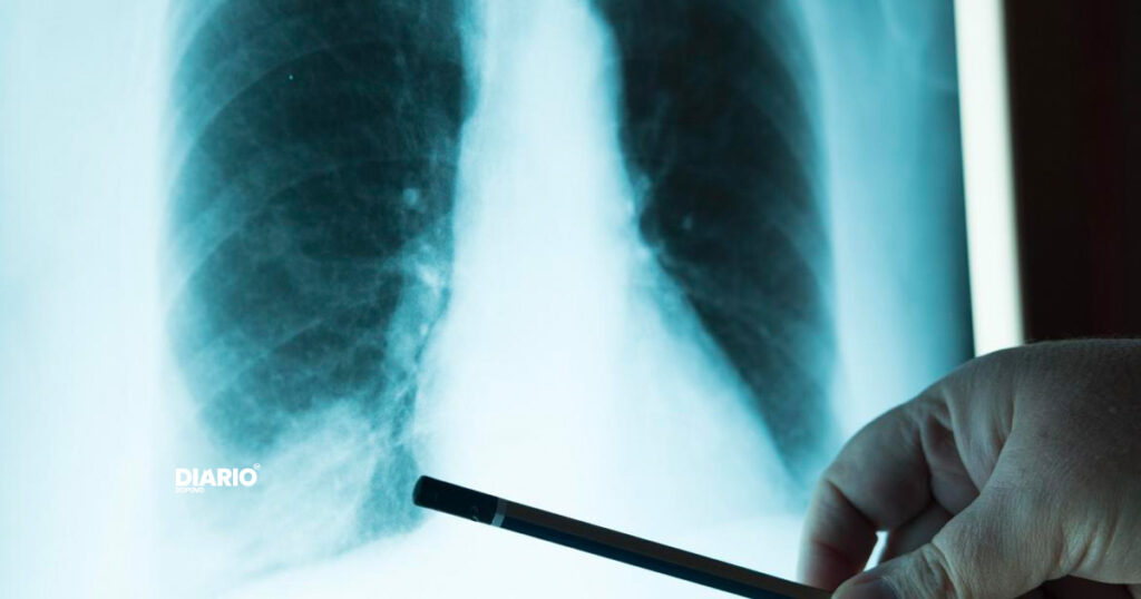 Estudo aponta resultados promissoes com nova droga contra câncer de pulmão