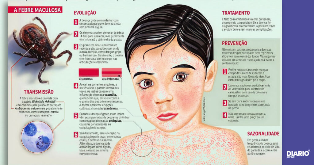 Sintomas da febre maculosa